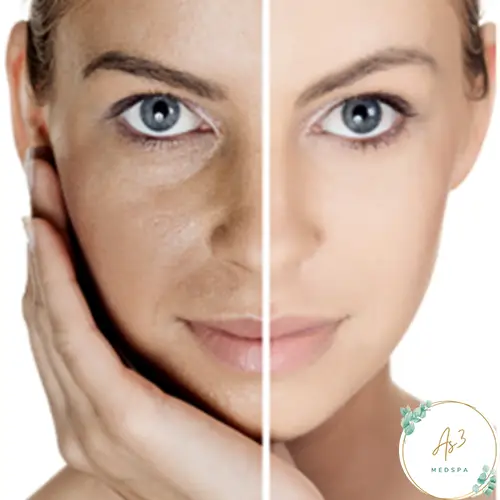 A mixed-race woman's face is shown in an image. On the left side of the picture is a before-and-after image. In the before part of the image, the left side of the face shows an uneven skin tone with slightly darker patches. In contrast, the after part of the image on the right shows the skin to be noticeably clearer and brighter. Both the before-and-after image and the word "Melasma" are displayed in front of a white background. On the bottom right is the AS3 MED SPA Logo in gold, covered in a circle with vines that are gold and green leaves stemming from the vine.