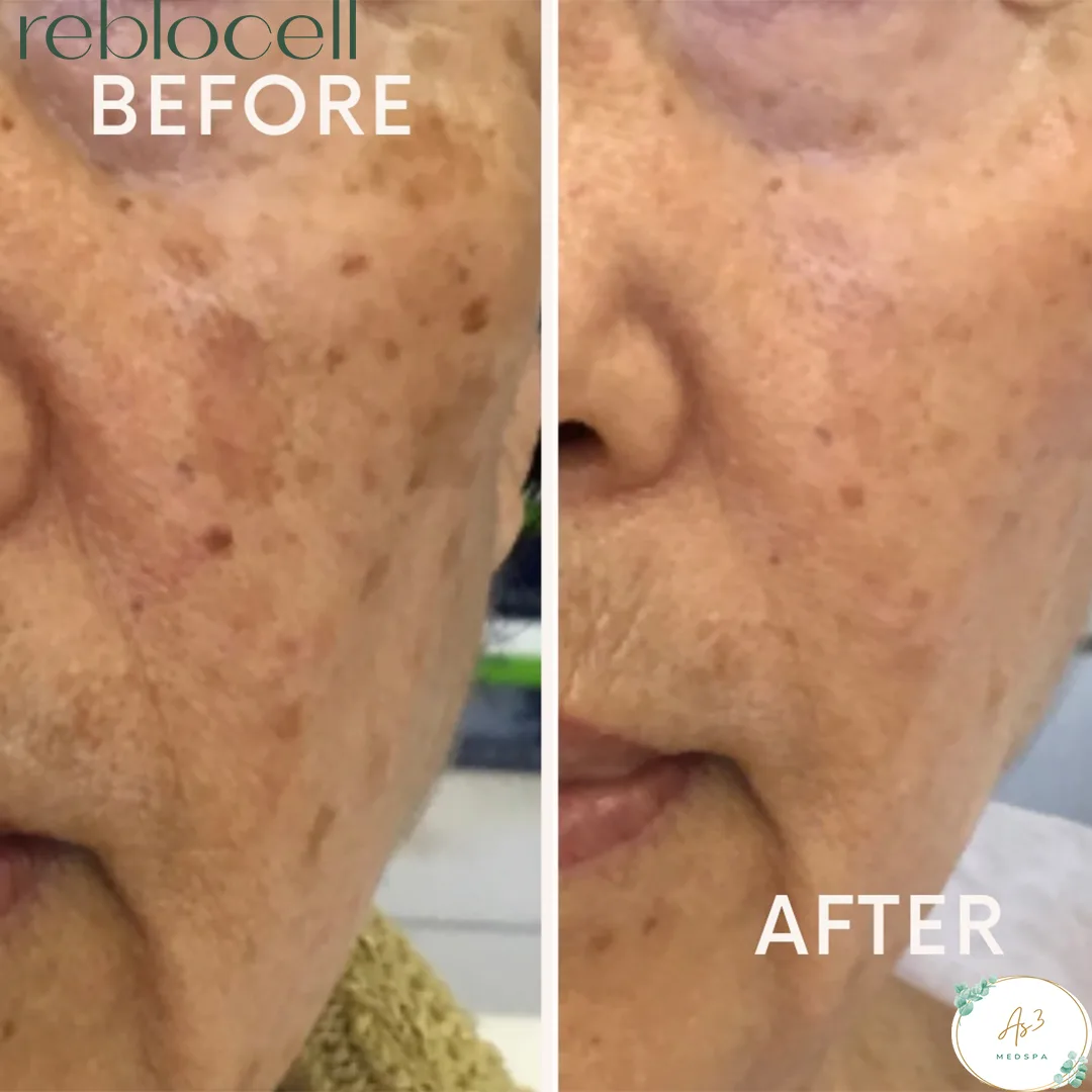 An image showcasing the before-and-after results of a laser treatment with MTS and EGF-infused ampoule & mask for a female client's aging spots and melasma at AS3 Med Spa. The left side of the image shows the client's face with visible discoloration, dark spots, and fine lines, while the right side shows the same area with improved clarity, brightness, and smoother-looking skin after the treatment.