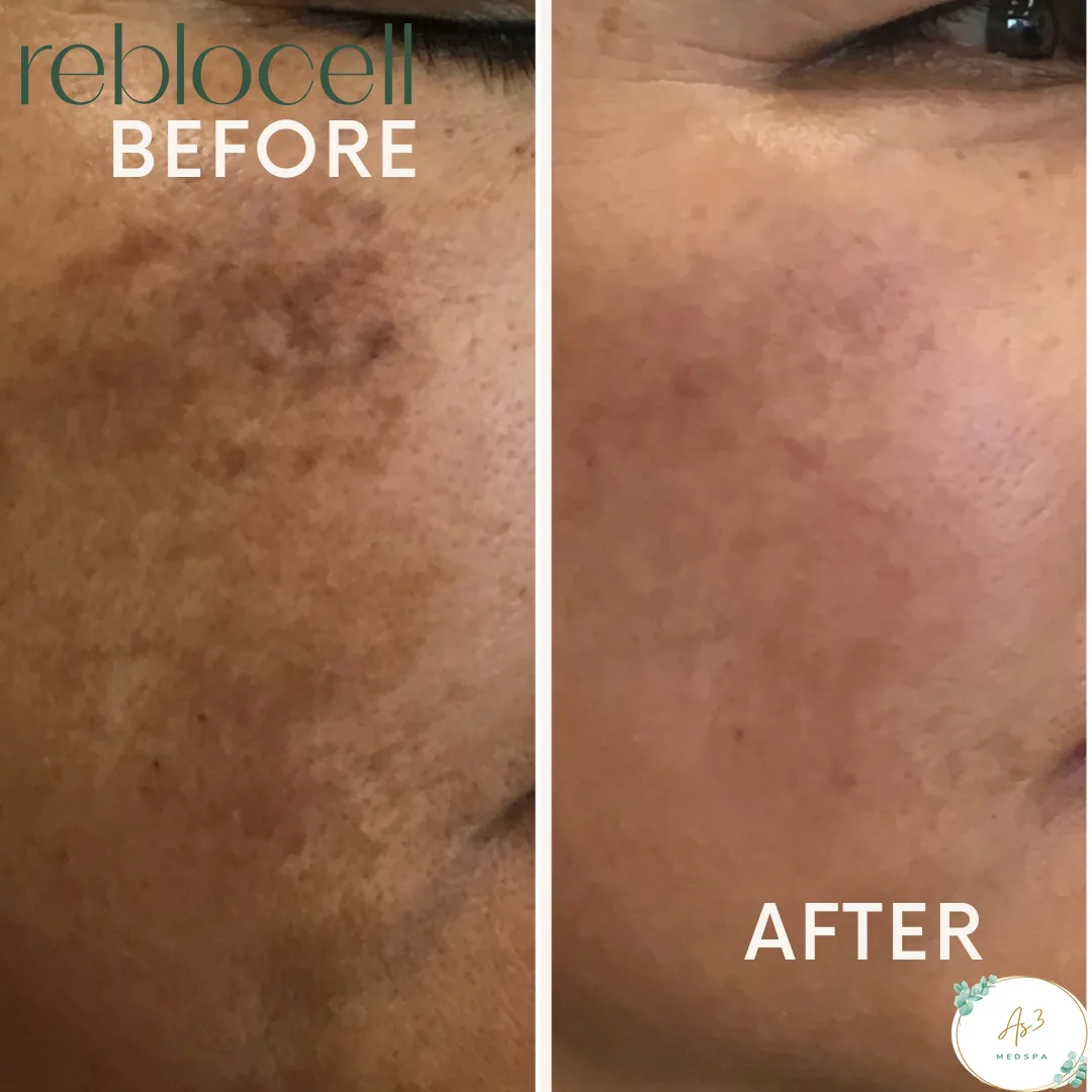 An image showcasing the before-and-after results of a laser treatment with MTS and EGF-infused ampoule & mask for a female client's melasma on the right side of the face at AS3 Med Spa. The left side of the image shows the client's face with noticeable discoloration and uneven skin tone, while the right side shows the same area with improved clarity, brightness, and smoother-looking skin after the treatment.