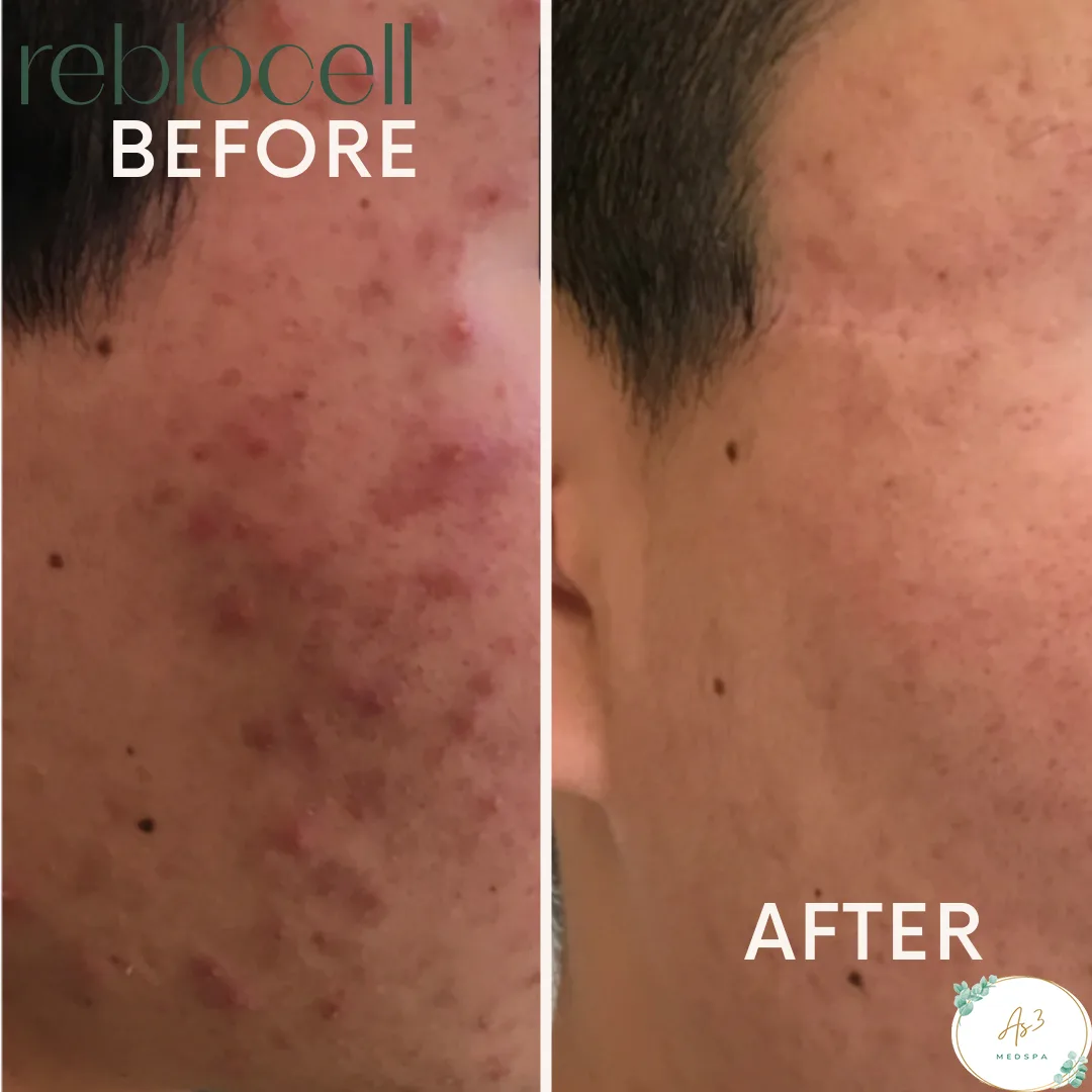 An image showcasing the before-and-after results of a laser treatment with MTS and EGF-infused ampoule & mask on the right cheek of a male client at AS3 Med Spa. The left side of the image shows the client's cheek with noticeable discoloration and uneven skin texture, while the right side shows the same area with improved clarity, brightness, and smoother-looking skin after the treatment.