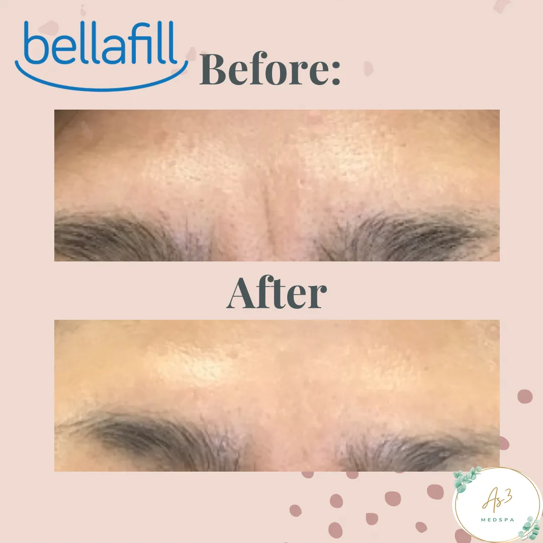 An image showcasing the before-and-after results of a Bellafill and botulinum toxin treatment for a female client's frown line at AS3 MED SPA. The top of the image shows the client's face with noticeable wrinkles and lines between the eyebrows, while the bottom shows the same area with smoother, more relaxed-looking skin after the treatment.