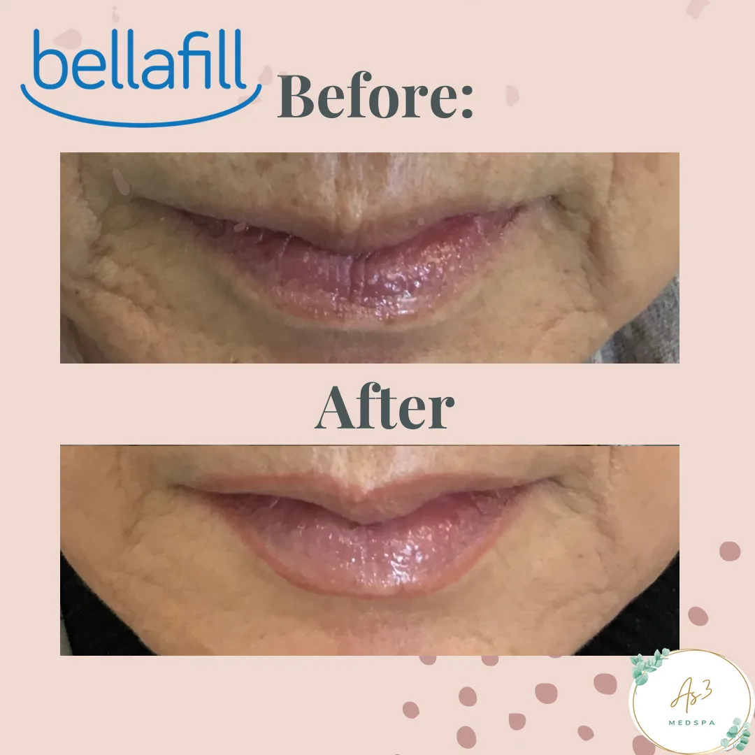 An image showing the before-and-after results of a Bellafill treatment for a female client's marionette lines at AS3 MED SPA. The top of the image shows the client's face with noticeable wrinkles around the mouth, while the bottom shows the same area with smoother, more youthful-looking skin after the treatment.