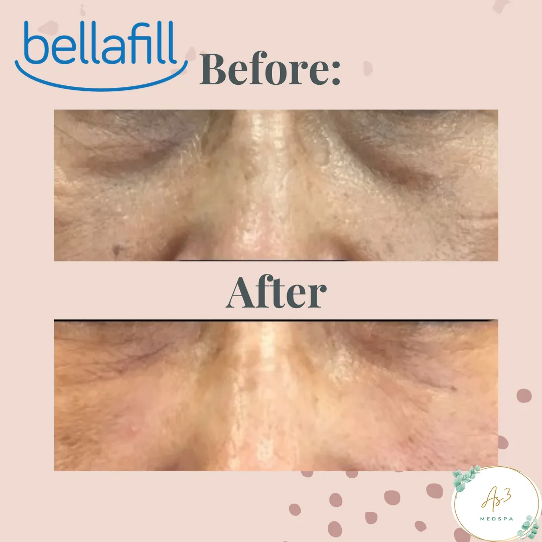 An image showcasing the before-and-after results of a Suneva Bellafill treatment for a female client's tear troughs under the eyes at AS3 Med Spa. The top of the image shows the client's face with dark circles and hollows under the eyes, while the bottom shows the same area with more volume and smoothness after the treatment.