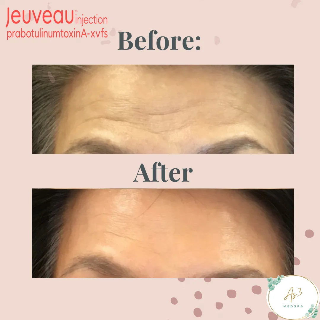 An image showcasing the before-and-after results of an Evolus Jeuveau #Newtox treatment for a female client's frown lines on the forehead at AS3 Med Spa. The top of the image shows the client's face with noticeable wrinkles and lines on the forehead, while the bottom shows the same area with smoother, more youthful-looking skin after the treatment.