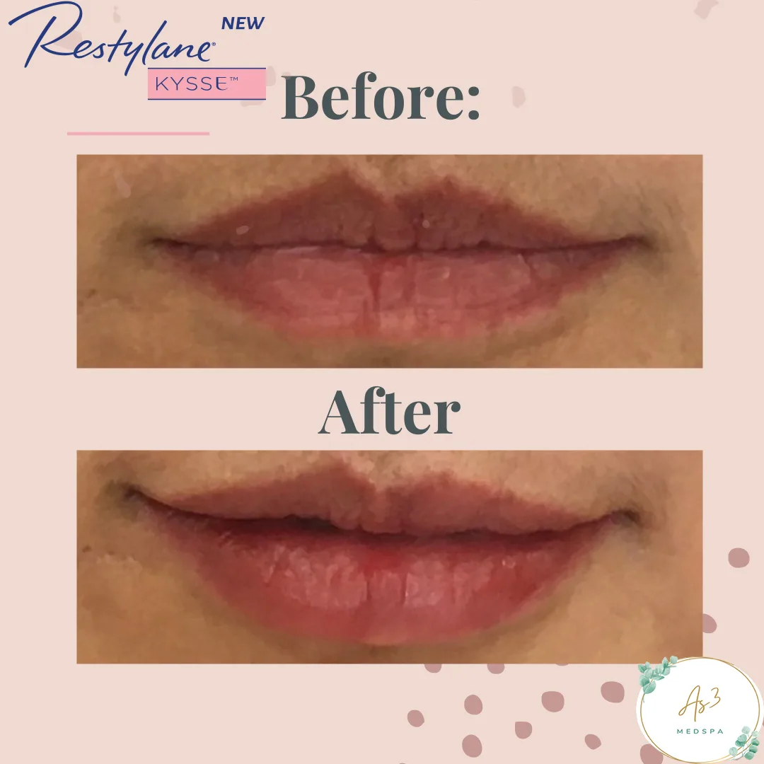 An image showcasing the before-and-after results of a Restylane Kysse treatment for a female client's lip volume augmentation at AS3 Med Spa. The top of the image shows the client's lips with a thin and undefined shape, while the bottom shows the same area with fuller, more plump-looking lips after the treatment.
