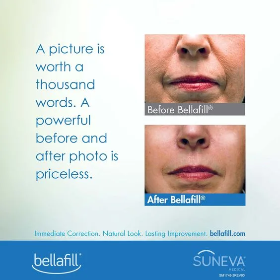 Bellafill-before-and-after-pic | AS3 Med Spa