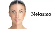 A mixed-race woman's face is shown with a before-and-after image on the left side of the picture. The word "Melasma" is displayed on the right of the before-and-after image. In the before part of the image, the left side of the face shows an uneven skin tone with slightly darker patches. In contrast, the after part of the image on the right shows the skin to be noticeably clearer and brighter. Both the before-and-after image and the word "Melasma" are displayed in front of a white background | AS3 Med Spa